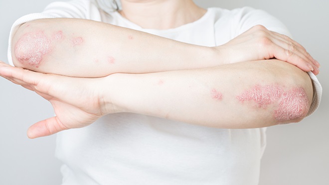 Tronco de mulher, vestida com t-shirt de manga curta branca, de braços cruzados, mostrando a zona dos cotovelos com manchas vermelhas e descamação de psoríase