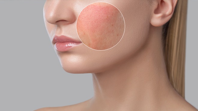 Rosto de mulher com área destacada com um círculo com alergia