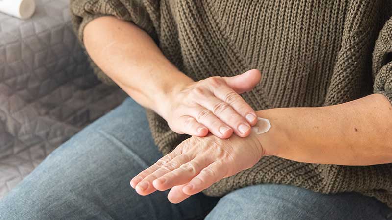 Mulher com pele sensível a colocar creme nas mãos