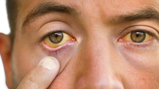 Pessoa com olhos amarelados