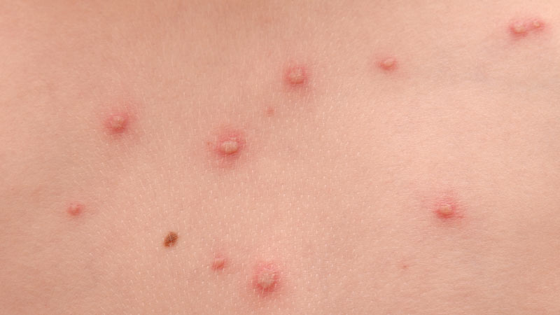 segunda fase da varicela (bolhas)