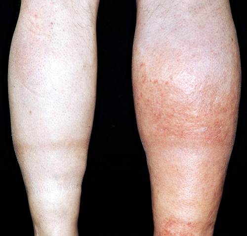 Alteração na cor da pele causada por tromboembolismo